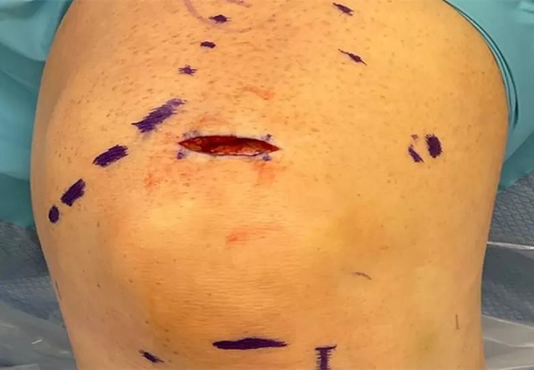 Incision