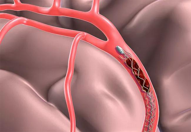 Thrombectomy 6 to 16 Hours After Stroke Onset Still Yields