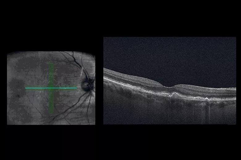 OCT of a 74-year-old with dry AMD.