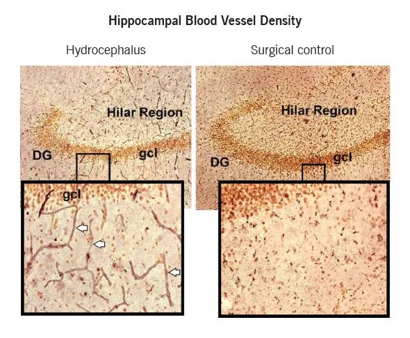 Figure 1. Photomicrographs showing increased blood vessel density in the canine hippocampus with chronic hydrocephalus (left) relative to a surgical control (right). DG = dentate gyrus; gcl = granule cell layer.  Reprinted from Neuroscience (Dombrowski et al4), ©2008 Elsevier BV.