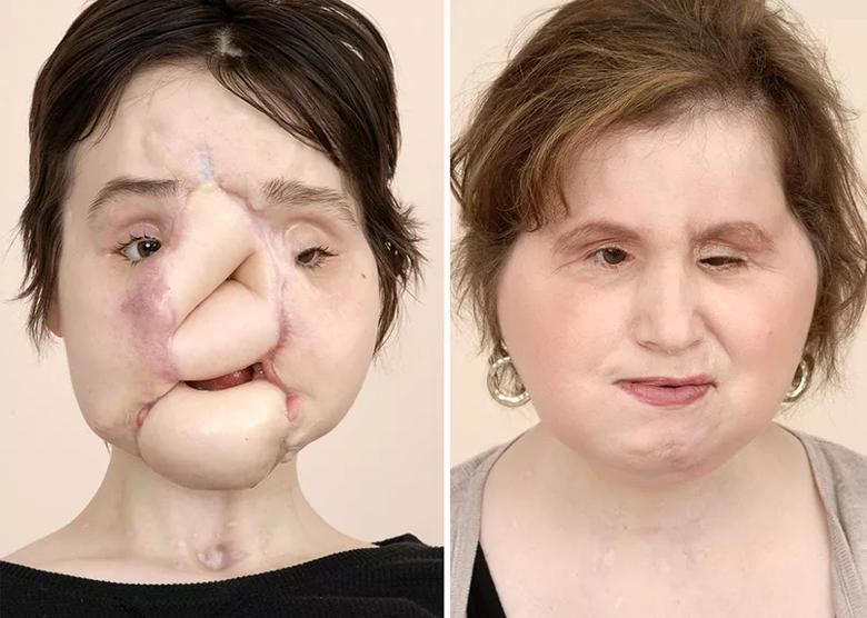 Total Face Transplant Before & After