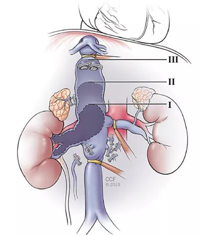 Inset-1