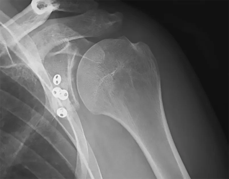 X-ray after arthroscopic glenoid reconstruction, showing buttons