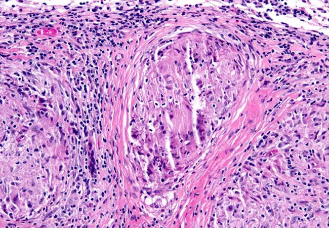An image of granuloma in meninges.