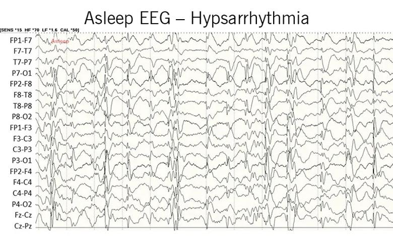 EEG recorded in a sleeping patient