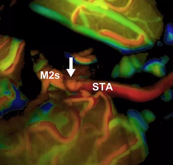 FLOW 800 time-to-arrival map after the bypass and occlusion of the aneurysm (and MCA superior trunk) with a clip.