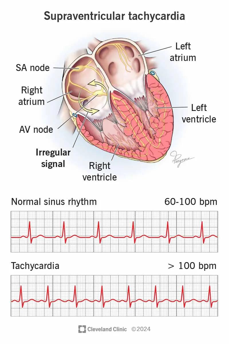 SVT (supraventricular tachycardia) is an abnormal heart rhythm that’s very fast and starts in the upper part of your heart