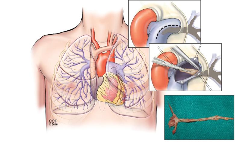 Pulmonary endarterectomy surgery