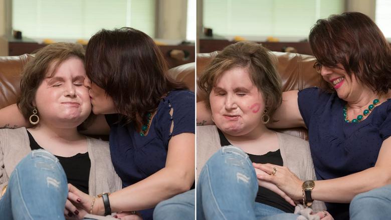 Katie Stubblefield face transplant Cleveland Clinic