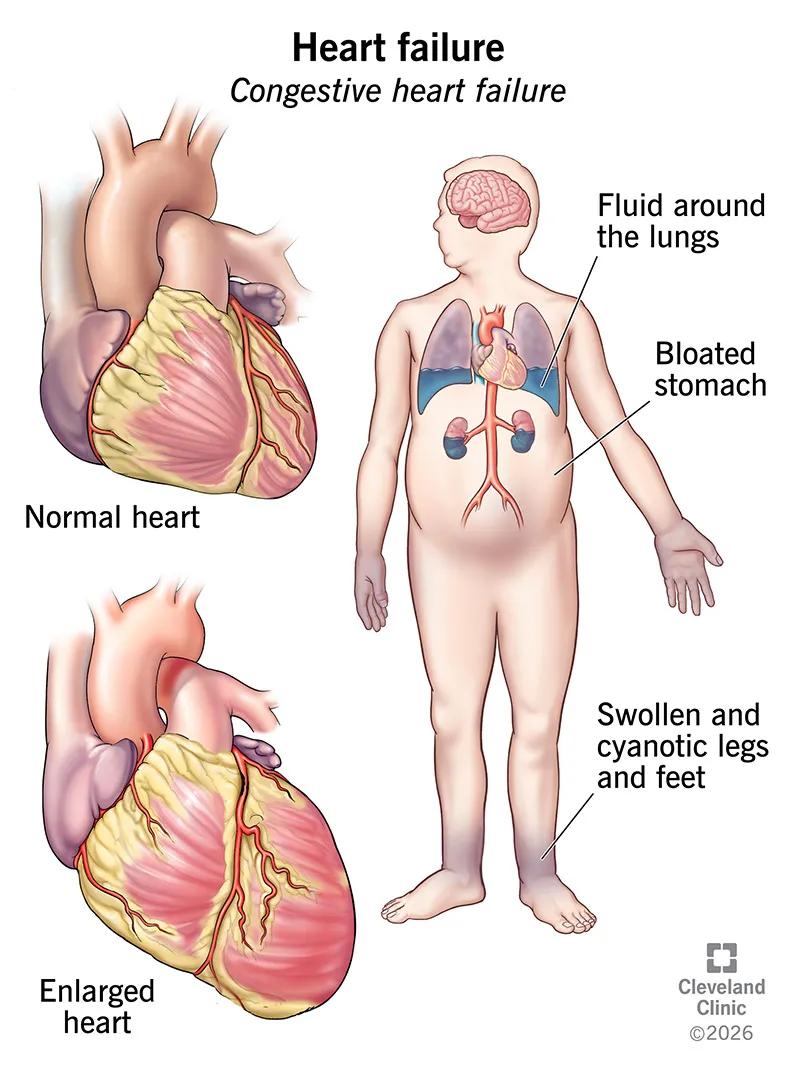 Signs of heart failure’s effects on your body, including fluid around lungs, bloated stomach, and swollen legs and feet