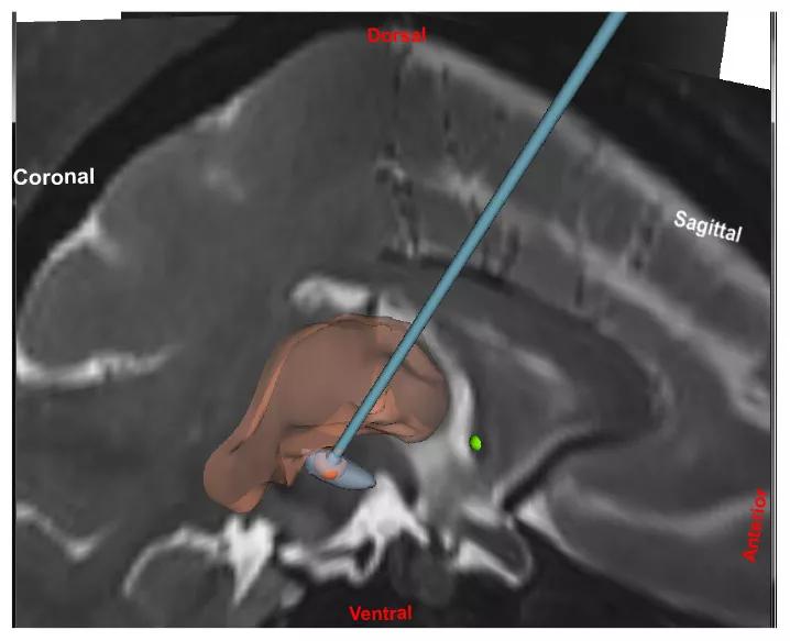 Figure 1. Representation of the coordinated reset DBS paradigm in two planes, with a view of how the DBS lead is targeted relative to coronal and sagittal MRIs.