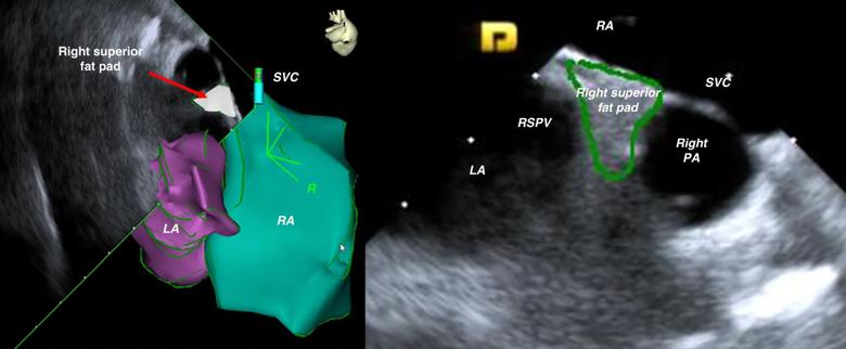 side-by-side heart scans with color overlays and text labels