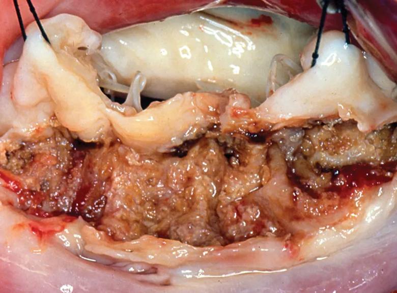 operative photo from heart surgery showing MAC debridement