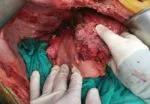 Second-stage (extended right) hepatectomy.