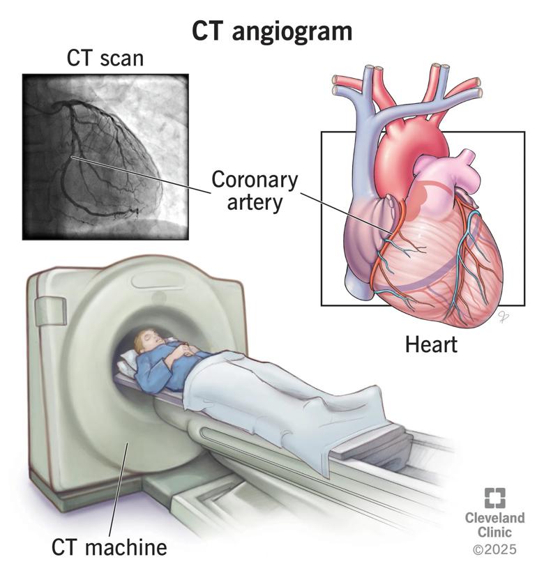 CT angiogram