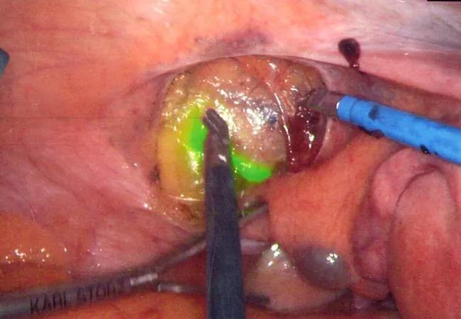 sentinel-lymph-node_650x450.jpg