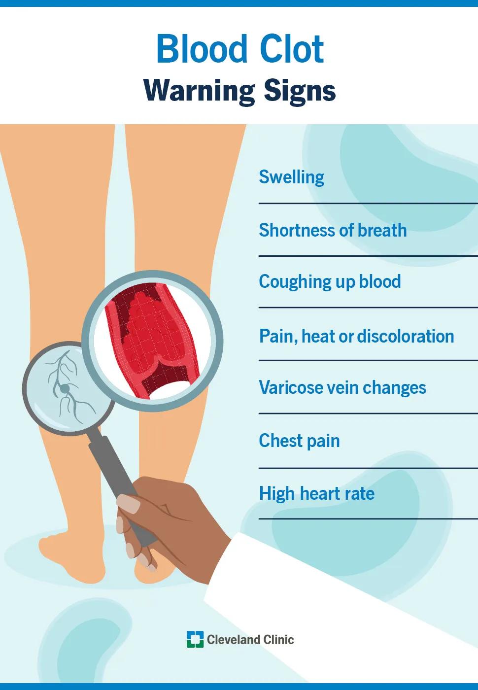 Blood clot warning signs