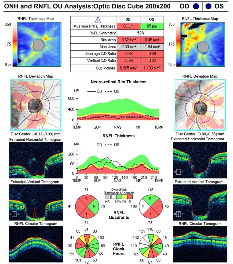 There is diffuse retinal nerve fiber layer thinning in the right eye. Given his normal IOP and visual field, this may be physiologic. The artifactual thickening superonasally in the left eye is from intra- and subretinal fluid. Note on the ‘extracted tomograms’ at the lower left that there is subretinal fluid superonasally. Also note the large disc area OD.