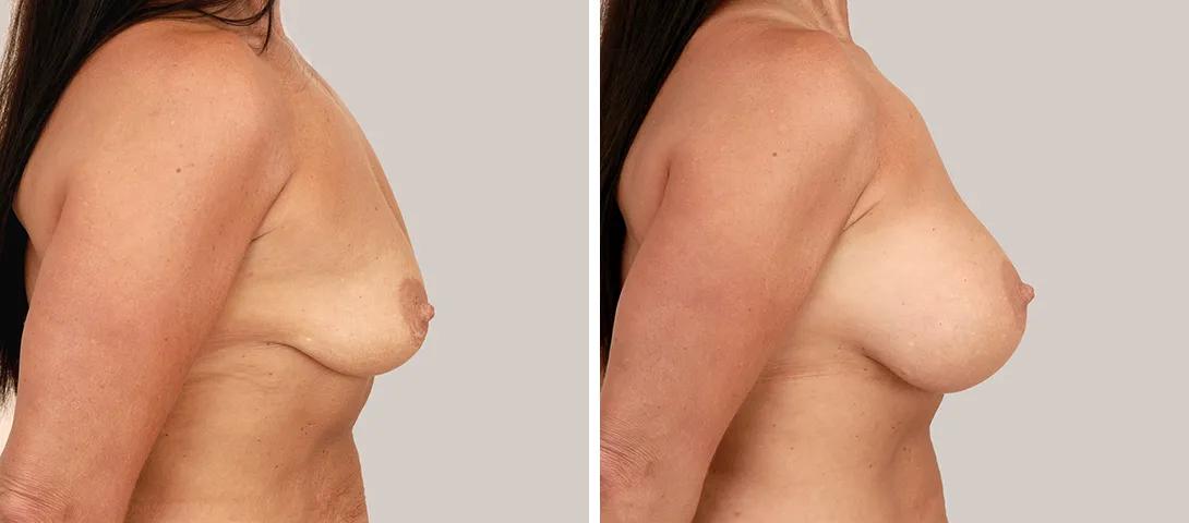 Breast augmentation before & after photo