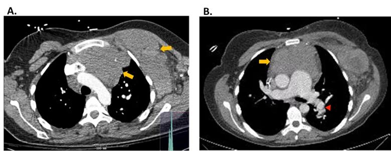 Figure 1. CT Chest