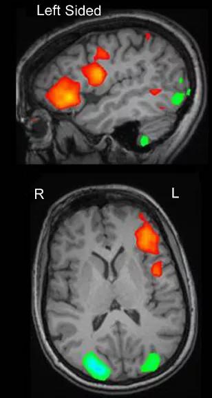FIGURE 1. Schematic illustration of cortical activation revealed with functional MRI within the left basal frontal lobe and anterior insula. Areas of interest are superimposed on sagittal and axial images of the patient’s structural MRI. Red indicates activation; green indicates deactivation.