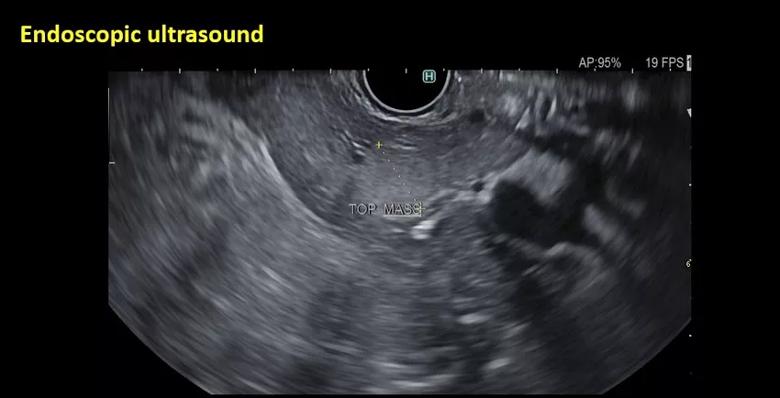 Endoscopic ultrasound image of lesion.