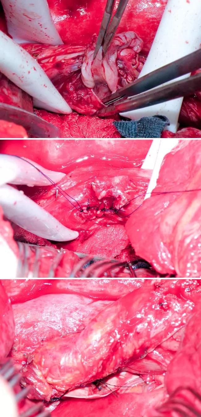 Figure 2. Top image shows the full-thickness esophageal defect. Middle image shows primary repair of the esophageal defect. Bottom image shows the intercostal muscle flap.