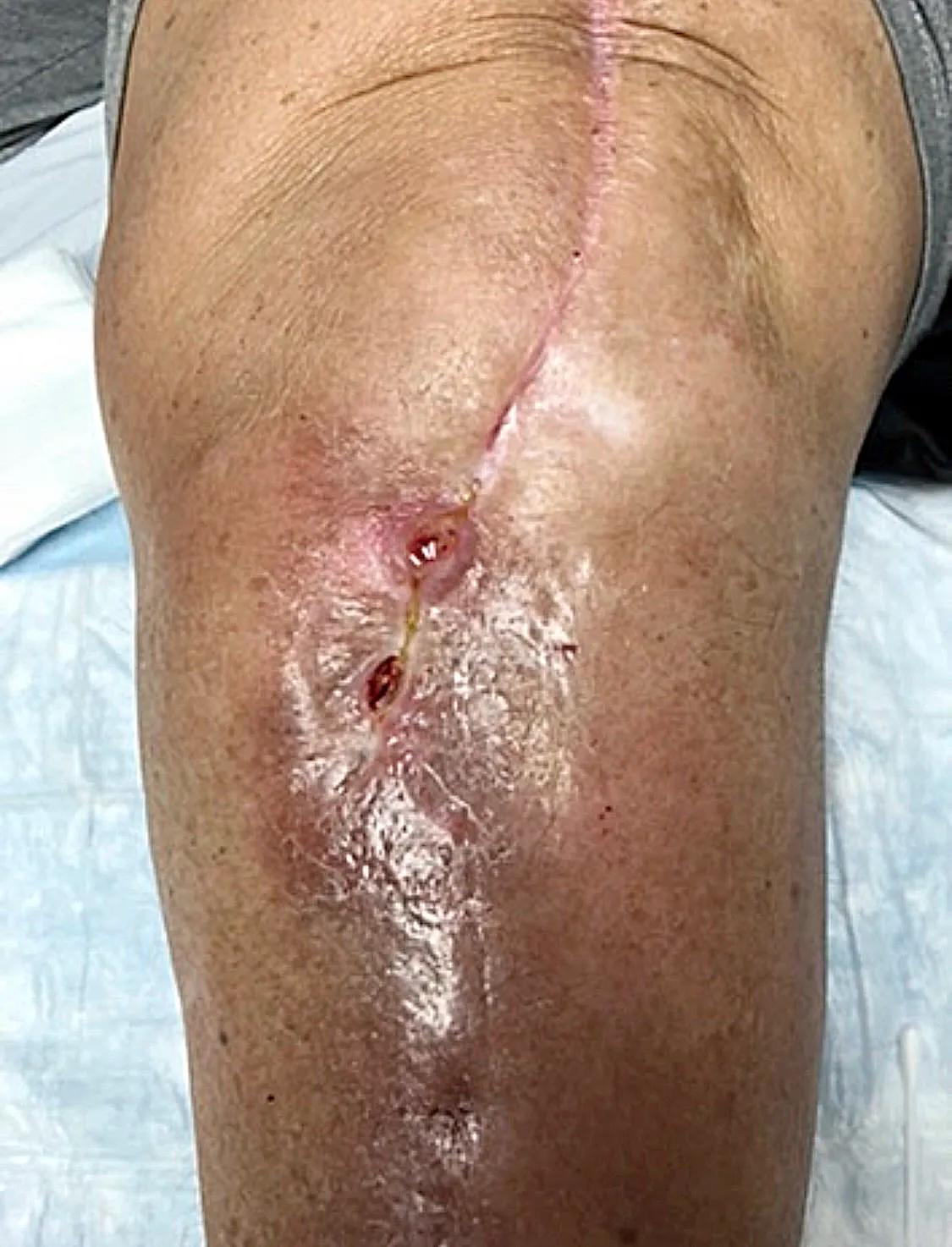 Joint infection after knee replacement