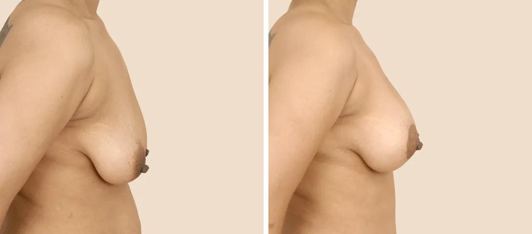 Before breast lift and augmentation (left) and 3 months after (right).