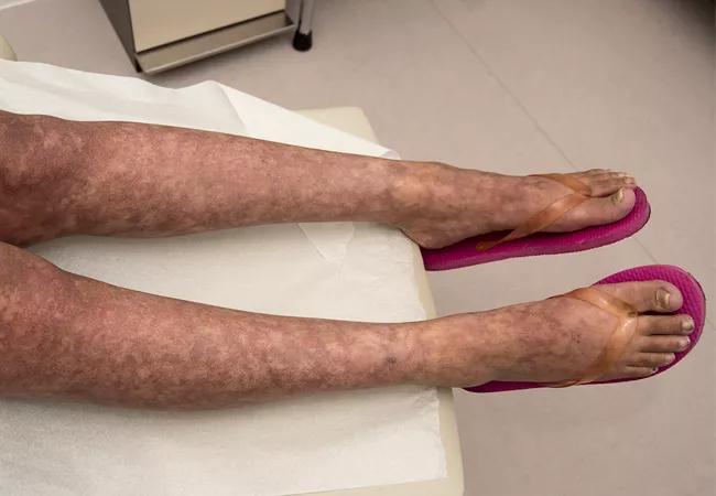 Pigmentation