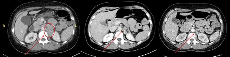 PET scans before & after therapy