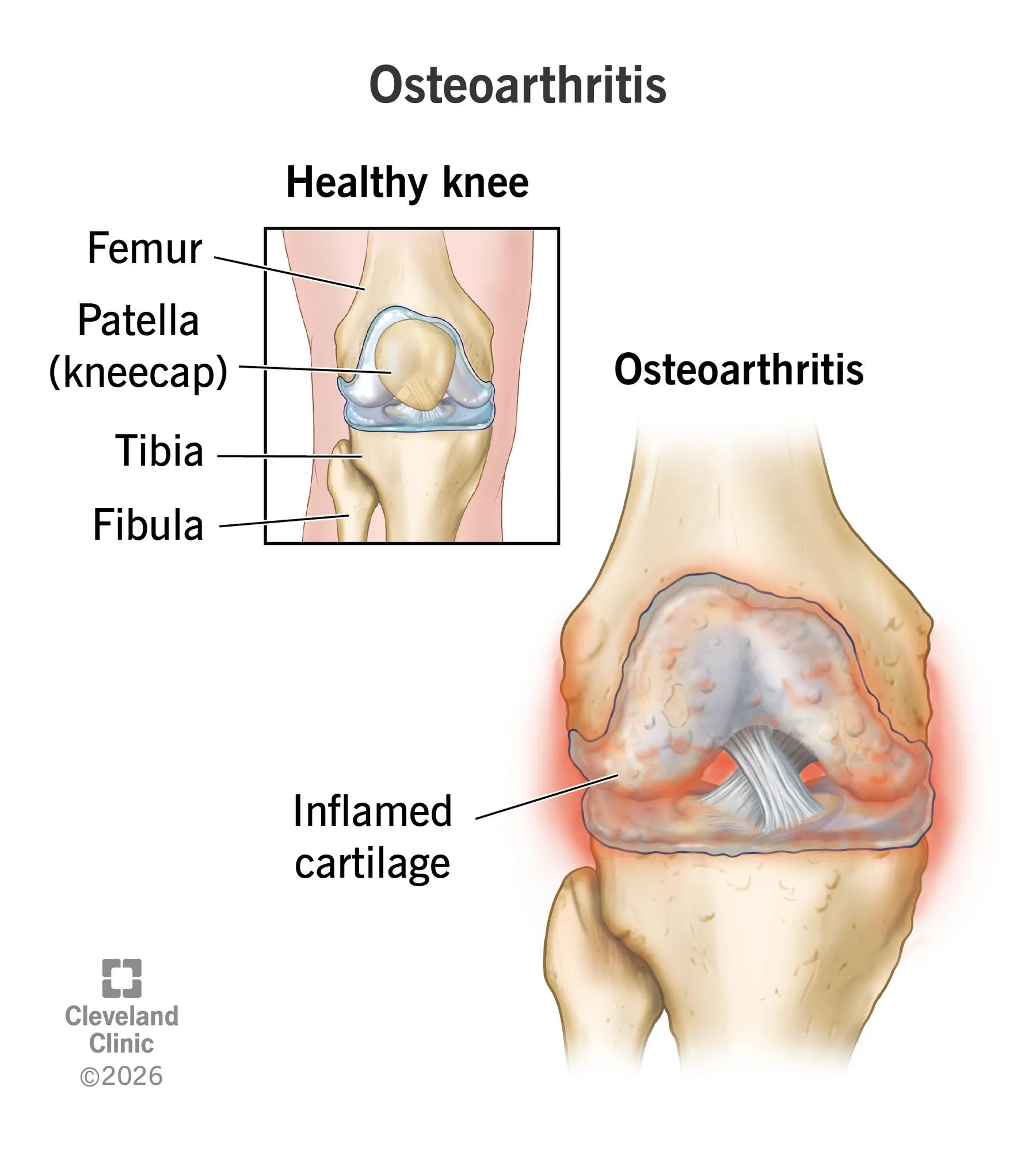 Anatomy of a healthy knee and a knee with osteoarthritis with inflamed cartilage
