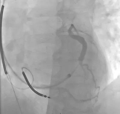 Figure 3. Coronary sinus venogram showing potential targets for percutaneous coronary sinus lead placement at the lateral and posterolateral branches.