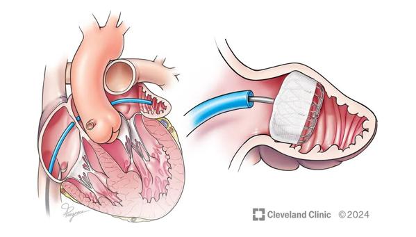 Medical illustration of a left atrial appendage closure procedure.