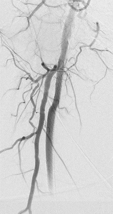 completed endovascular stent graft placement in a leg blood vessel