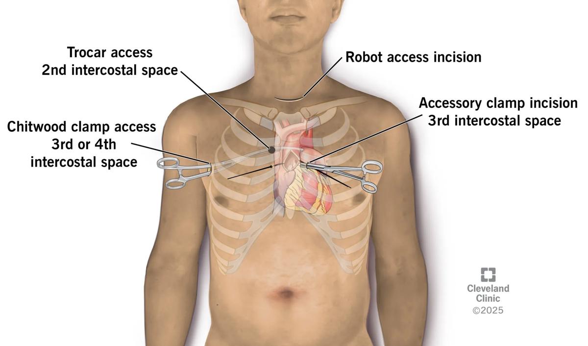 labeled illustration of ribs and heart in human chest