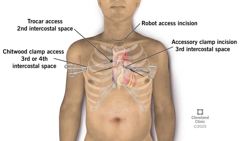labeled illustration of ribs and heart in human chest