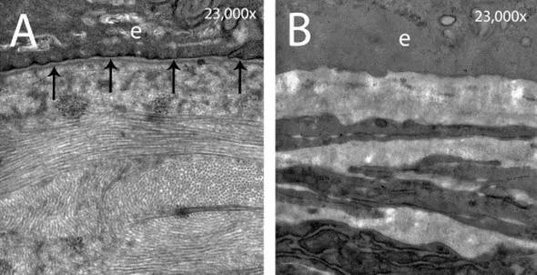 eye corneal scarring