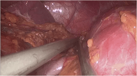 15-URL-063-Nephrectomy-fig2