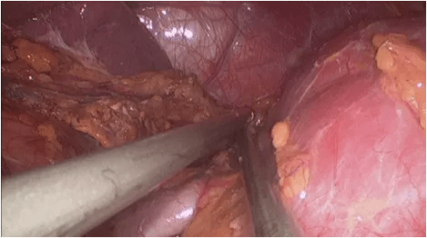 15-URL-063-Nephrectomy-fig2