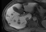 Preoperative computed tomography shows extensive bilobar liver metastases from colorectal cancer.