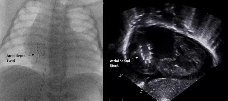 Angiogram and echo taken after atrial septal stent placement.