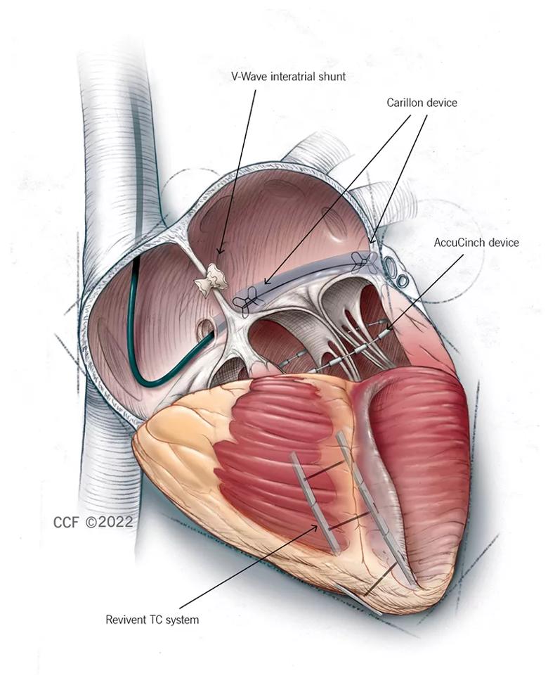 Illustration of the four featured interventional approaches.