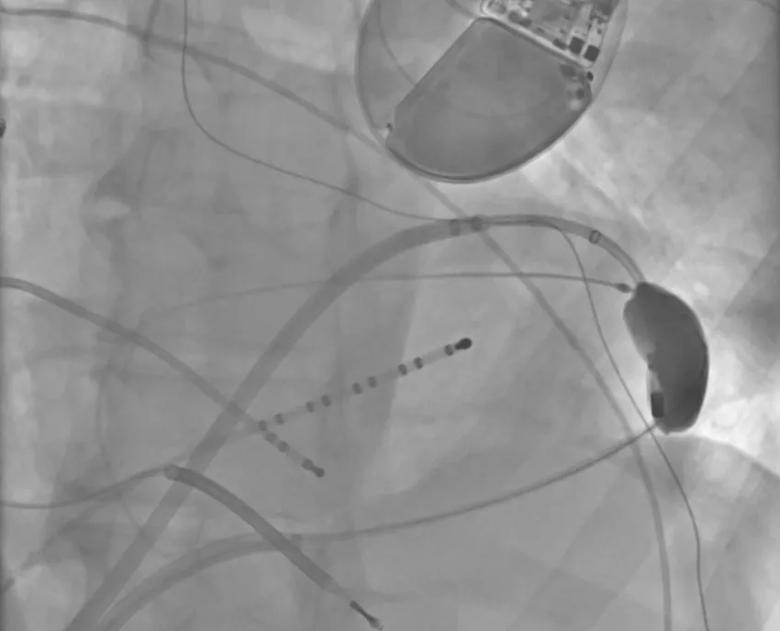 An epicardially positioned inflated balloon protects the phrenic nerve while radiofrequency ablation is delivered.
