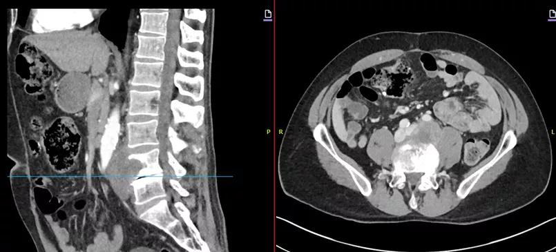 two side-by-side scans of a section of a human spine with surrounding organs