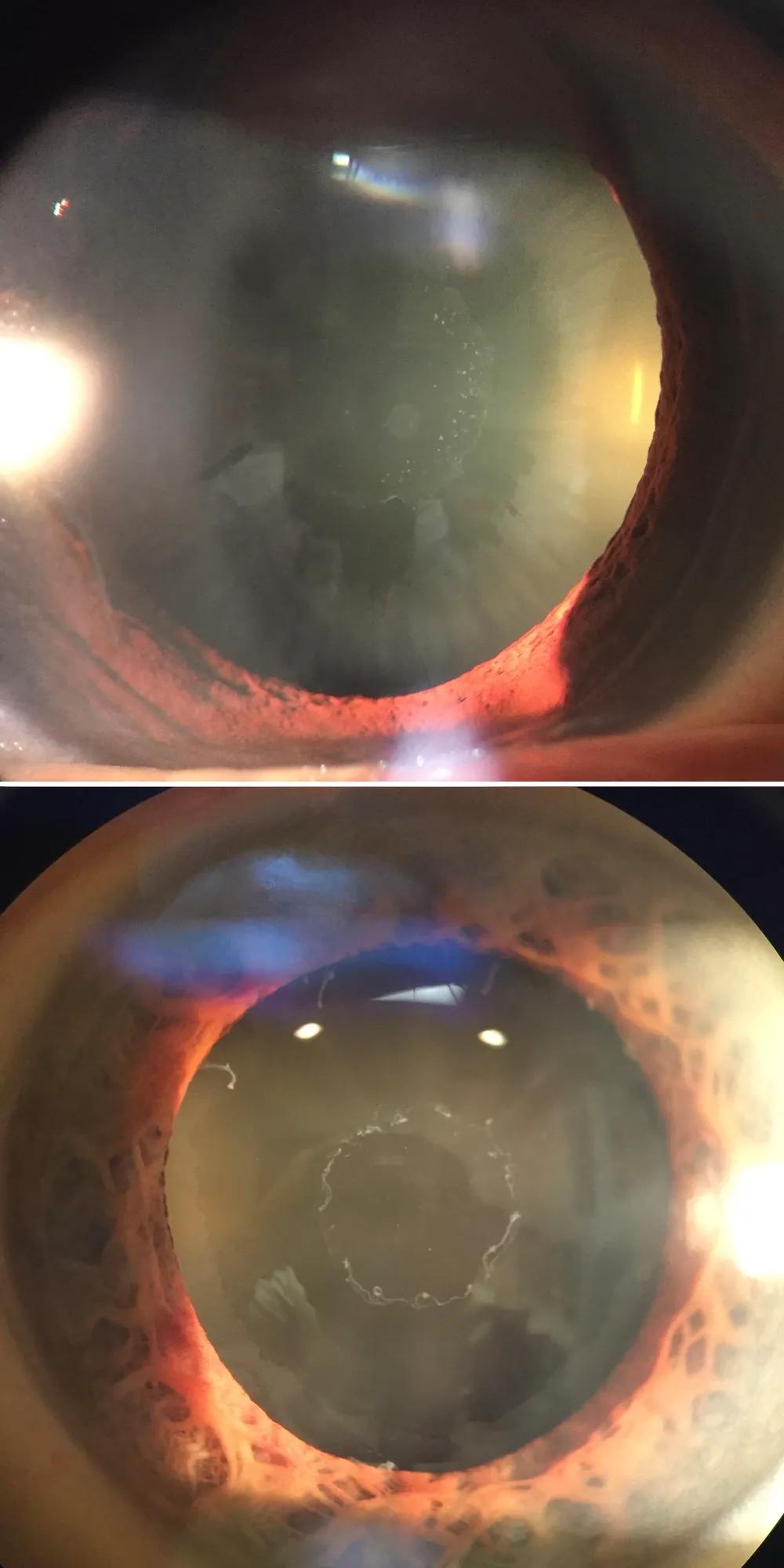 pseudoexfoliation glaucoma
