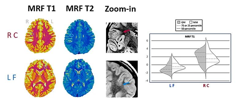 two rows of three brain images with varying color schemes