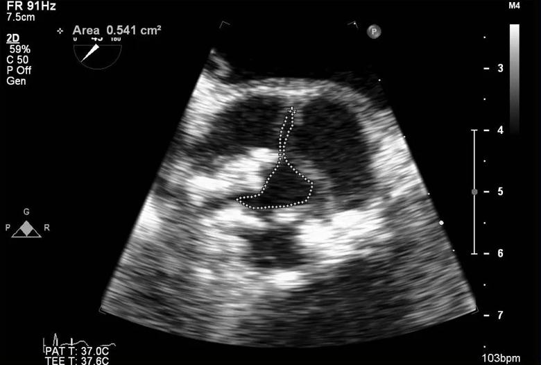 echocardiogram showing severe aortic stenosis