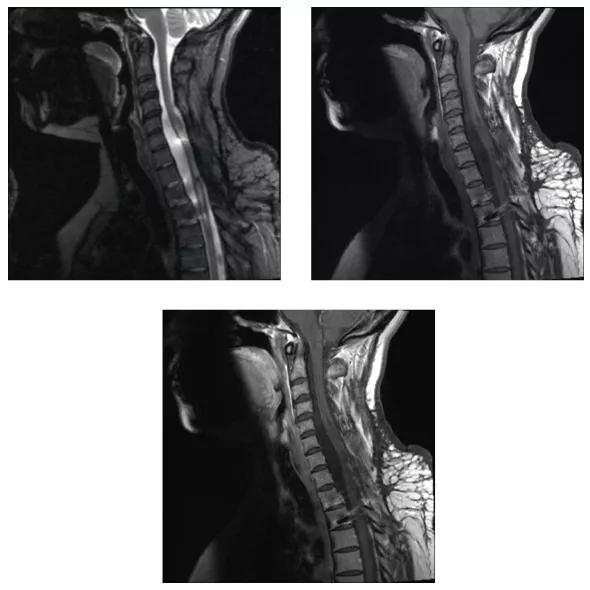 benzel-tumor-fig3