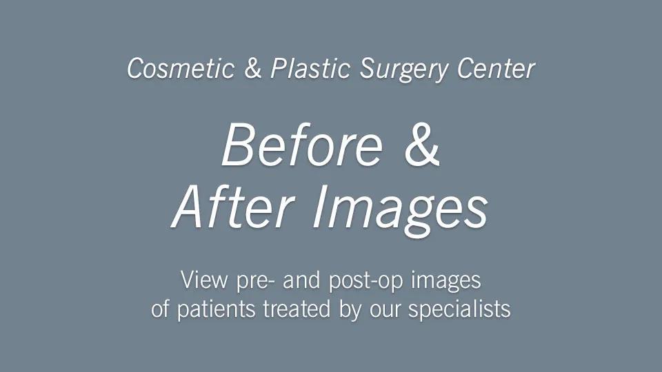 Cosmetic & Plastic Surgery Center Before & After Images